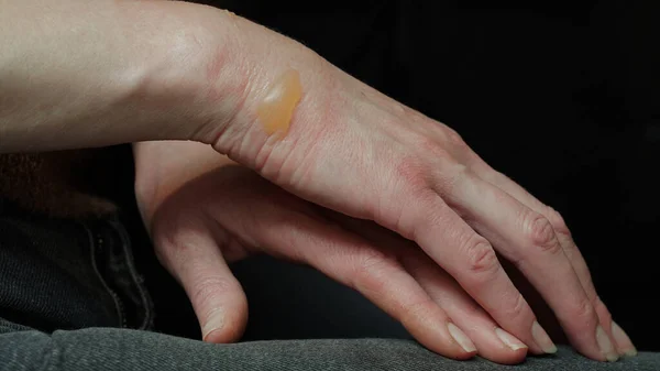 Närbild Kvinnas Hand Med Blåsa Från Kokt Vattenbränna Skadad Hud — Stockfoto