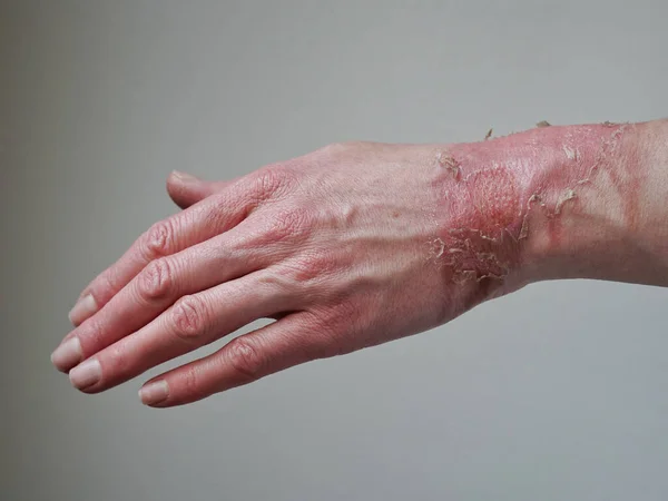 Close-up of a woman\'s hand with a burst blister from a boiled water burn, broken skin, 1st or 2nd degree burn. Painful wound. Thermal burn. Skin peels off after a burn, wound treatment. macro photo.