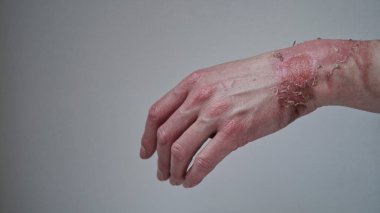 Kaynamış su yanığı, kırık deri, birinci ya da ikinci derece yanık yüzünden su toplamış bir kadının eline yakın çekim. Acı verici bir yara. Termal yanık. Yanıktan sonra derisi soyuluyor, yara tedavisi görüyor. makro fotoğraf.