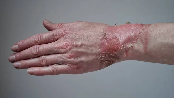 Zbliżenie Ręki Kobiety Pękniętym Pęcherzem Oparzenia Gotowanej Wody Złamana Skóra — Zdjęcie stockowe