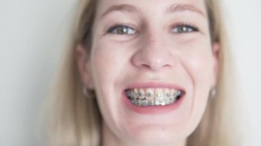 Close-up of a womans face with braces on her teeth.