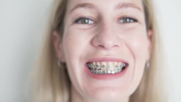 Close Womans Face Braces Her Teeth — Stok video