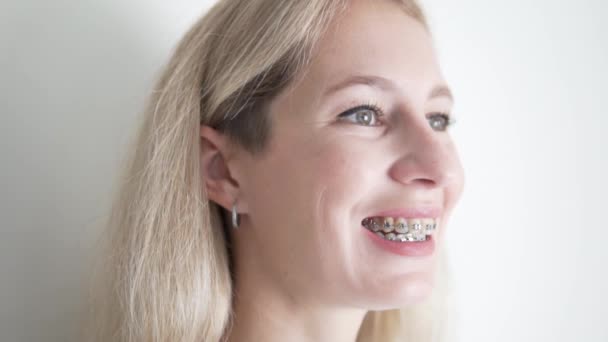 Close Her Face Young Woman Braces Her Teeth Smiling — Vídeo de Stock