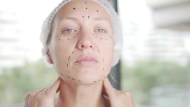 Detailní Záběr Ženské Tváře Označením Pro Injekce Botoxu — Stock video