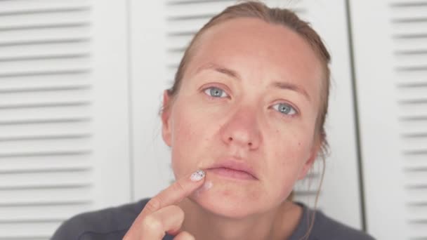 Vrouw Die Gemedicineerde Crème Aanbrengt Herpes Gezicht Buurt Van Kin — Stockvideo