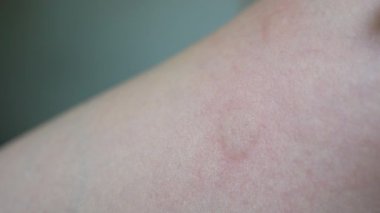 Extreme Close of Hand Apping İlaç to Urticia at Bacak Derisi