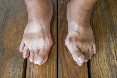 Hallux Valgus ya da İki Ayağın Şişliği