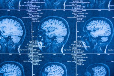 Tarayıcı tarafından elde edilen beyin tomografisi.