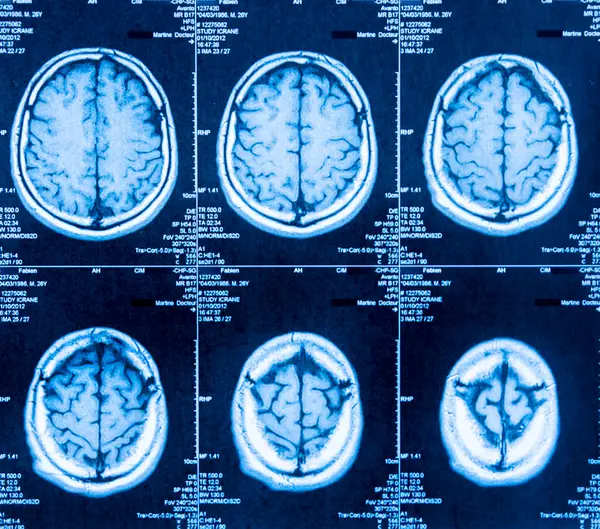 Tomography Brain Obtained Scanner — Stock Photo, Image