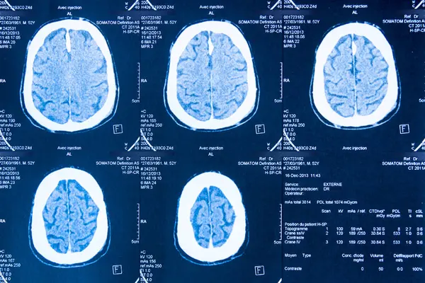 Tomografía Del Cerebro Obtenida Por Escáner Fotos de stock