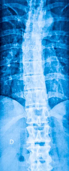 Ray Spine Affected Scoliosis Frontal View Εικόνα Αρχείου