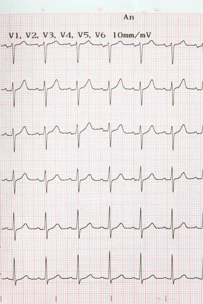 Electrocardiograma Corazón Humano Vista Primer Plano Imagen de stock