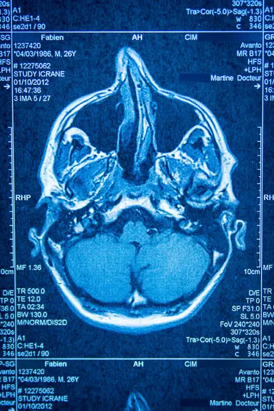 扫描机获得的脑部断层扫描 免版税图库图片