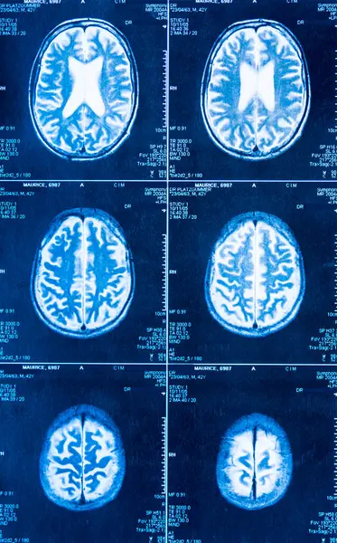 Tomografía Del Cerebro Obtenida Por Escáner Imagen de archivo