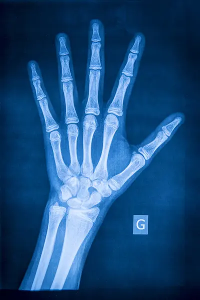 Radiografia Normal Mão Esquerda Imagem De Stock