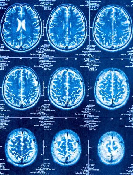 Tomography Brain Obtained Scanner Εικόνα Αρχείου