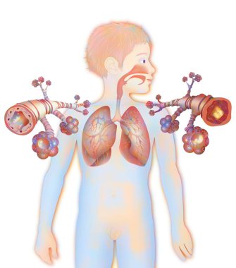 Depiction of a healthy bronchial tube (left) and a bronchial tube during an asthma attack (right). clipart