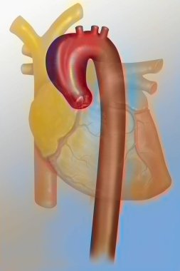 Aneurysm of the ascending thoracic aorta (aortic arch). An aneurysm is a localized dilation of the wall of a blood vessel (pocket of blood), the rupture of which can be fatal (hemorrhage).  clipart