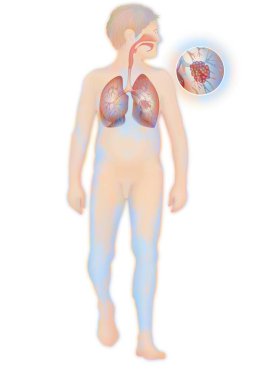 Depiction of a cancerous tumour in the left lung. clipart