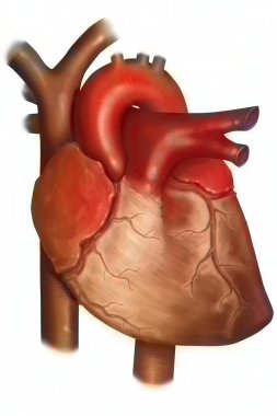 Myocardial infarction. Myocardial infarction is a necrosis of a part of the heart muscle following the cessation of blood supply (ischemia) clipart