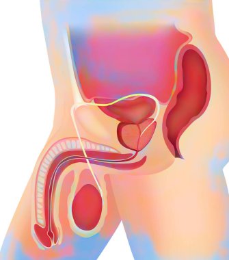 Protez adenoma, beyaz arkaplanda çizim