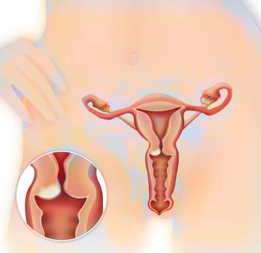 Rahim ağzı kanseri. Tıbbi çizim, insan anatomisi.