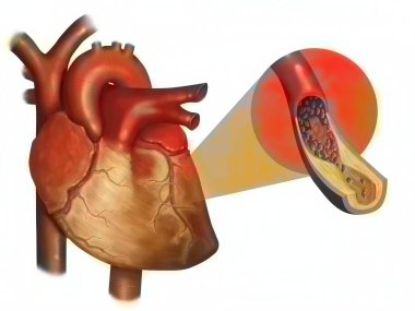 Myocardial infarction (atheroma plaque). A myocardial infarction is a necrosis of a part of the heart muscle following an obstruction of a coronary artery.  clipart