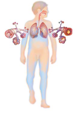 Depiction of a healthy bronchial tube (left) and a bronchial tube during an asthma attack (right). clipart