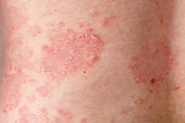 慢性乾癬のフラグメント皮膚 男性の体にバルガリスパッケージ 遺伝子免疫疾患について 治療後の改善 — ストック写真