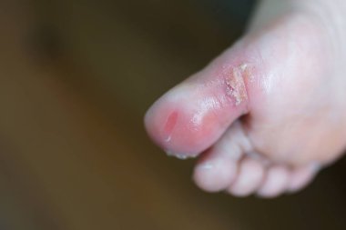 Enfekte olmuş ayak tırnağının yere yakın plan görüntüsü. 