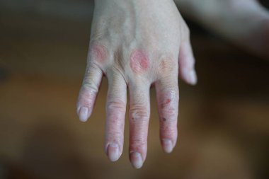 Kızarıklık isiliği yüzünden ellerim kaşınıyor. Kaşınan derinin nedeni deri iltihabı (egzama), kuru cilt, yanık, yiyecek, ilaç alerjisi, böcek ısırıkları. Sağlık hizmeti kavramı.