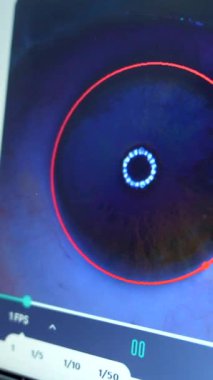 Göz doktoru tarafından glokom tedavisi sırasında lazer uygulamasını gözlemlemek için kullanılan ekran.