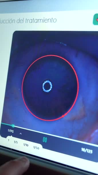 眼科医によって使用されるスクリーンは患者の緑内障の処置の間にレーザーの適用のための目を監視します — ストック動画
