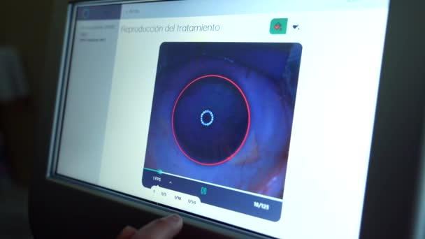 Bildschirm Des Augenarztes Zur Überwachung Des Auges Auf Laserapplikation Während — Stockvideo