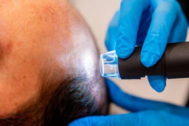 Bir güzellik kliniğinde kel bir adam için lazer tedavisi uygulayan bir dermatoloğun ellerine yakın çekim.