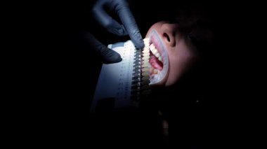 Siyah eldiven giyen dişçi diş beyazlatma işlemi sırasında hastanın dişlerinin rengini belirlemek için bir gölge rehberi kullanıyor.