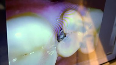 Ayrıntılı diş dolgu prosedürünü gösteren hassas diş monitörü modern diş sağlığı kliniğinde profesyonel restorasyon tekniğini gösteriyor