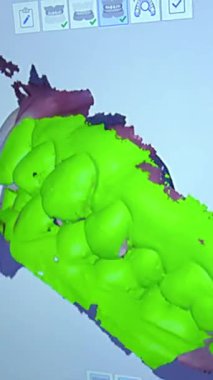 Dijital diş taraması, diş yüzeylerini vurgulayan, teşhis ve tedavi planlamasında dişçiye yardım eden