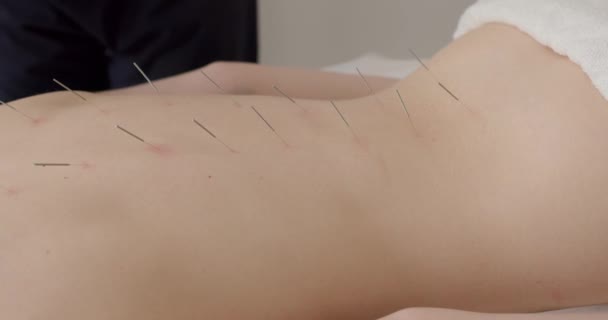 Arts Voegt Naalden Huid Van Vrouw Gezondheidsproblemen Behandelen Man Acupuncturist — Stockvideo