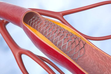 Stent ile koroner anjiyoplasti (perkütan koroner müdahale veya PCI) kalbe giden kan akışını iyileştirmeye yardımcı olur. 3 Boyutlu Canlandırma