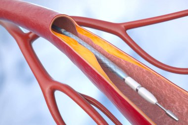 Stent ile koroner anjiyoplasti (perkütan koroner müdahale veya PCI) kalbe giden kan akışını iyileştirmeye yardımcı olur. 3B illüstrasyon