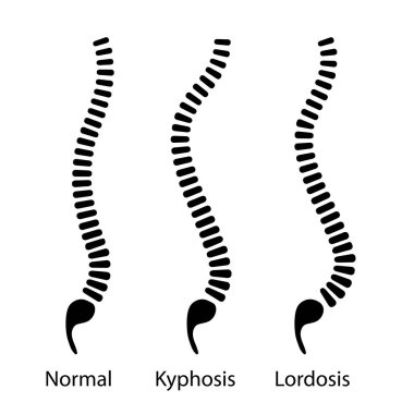 Omurga deformasyonu olan siyah monokrom posteri