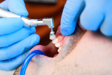 Hassas diş beyazlatma tedavisi devam ediyor. Detaylı bir yakın plan çekimde ele geçirildi.