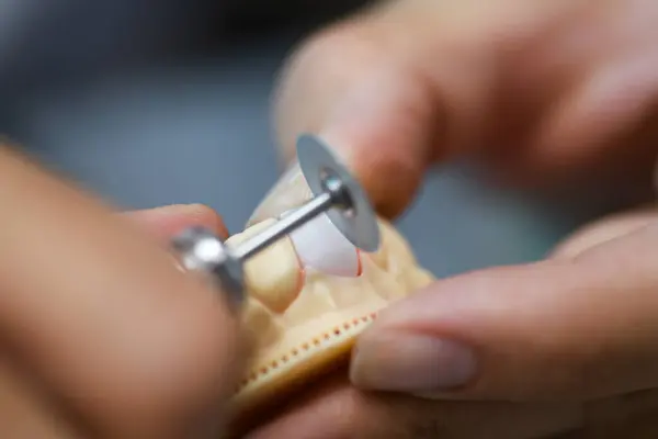 Close Prosthetic Dental Craftsmanship Showcasing Detailed Work Creating Dental Prosthesis — Stock Photo, Image