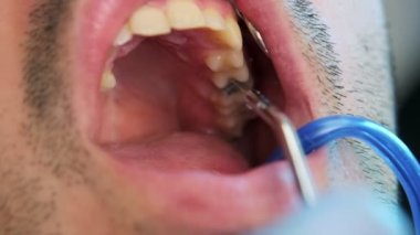 Bir diş durulama prosedürünü gösteren, hastanın ağzına su veya dezenfektan uygulanmasına odaklanan yavaş çekim videosu.