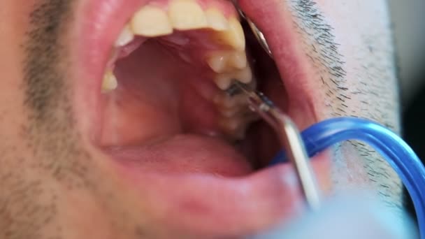 Vídeo Cámara Lenta Primer Plano Que Muestra Procedimiento Enjuague Dental — Vídeos de Stock