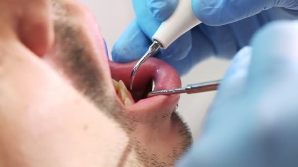 Close Αργή Κίνηση Βίντεο Συλλαμβάνει Σχολαστική Διαδικασία Της Οδοντικής Κλιμάκωσης — Αρχείο Βίντεο