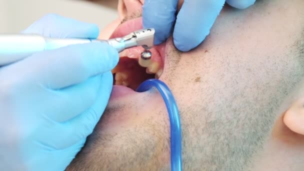 Tartarı Çıkarmak Ağız Sağlığını Korumak Için Dişlerin Titiz Bir Şekilde — Stok video