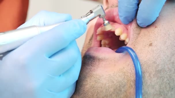 Acercamiento Imágenes Cámara Lenta Que Muestran Meticuloso Proceso Descamación Dental — Vídeos de Stock