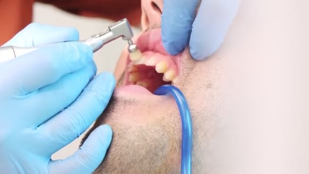 Acercamiento Imágenes Cámara Lenta Que Muestran Meticuloso Proceso Descamación Dental — Vídeo de stock